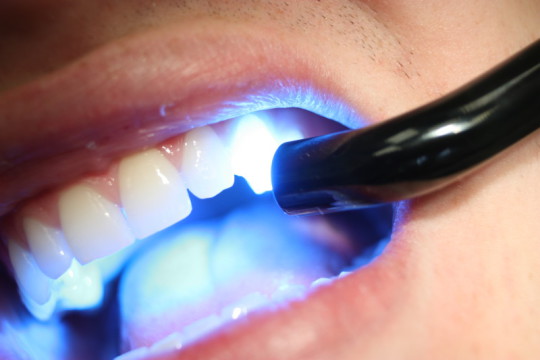 cách khắc phục răng bị mẻ 3