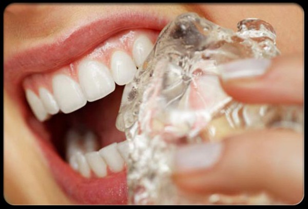 cách khắc phục răng bị mẻ 2