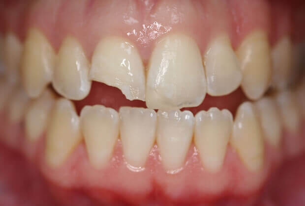 cách khắc phục răng bị mẻ