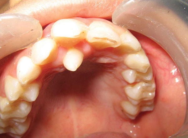 nhổ răng thừa có nguy hiểm không 2