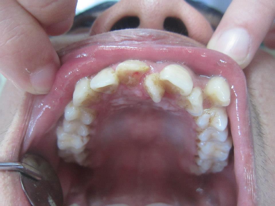 nhổ răng thừa có nguy hiểm không 3