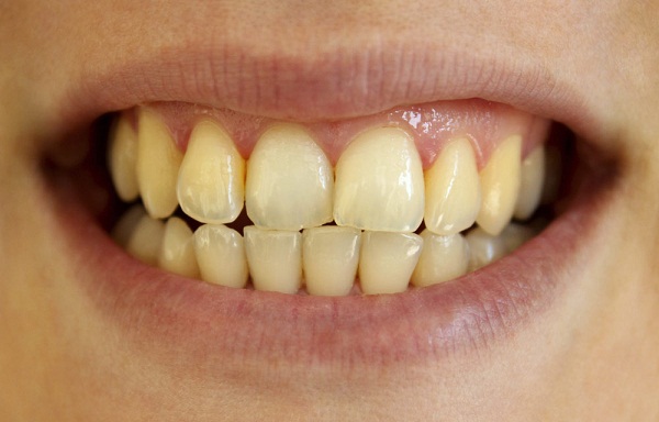 tại sao răng bị vàng