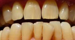 Tại sao răng bị vàng? – Điểm mặt những tác nhân không thể ngờ đến