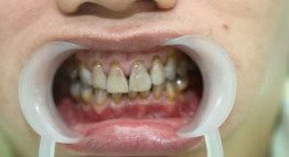 Răng nhiễm kháng sinh có tẩy trắng được không? – Lý giải từ chuyên gia