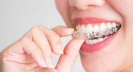 Tẩy trắng răng bằng máng bao nhiêu tuổi thực hiện được?