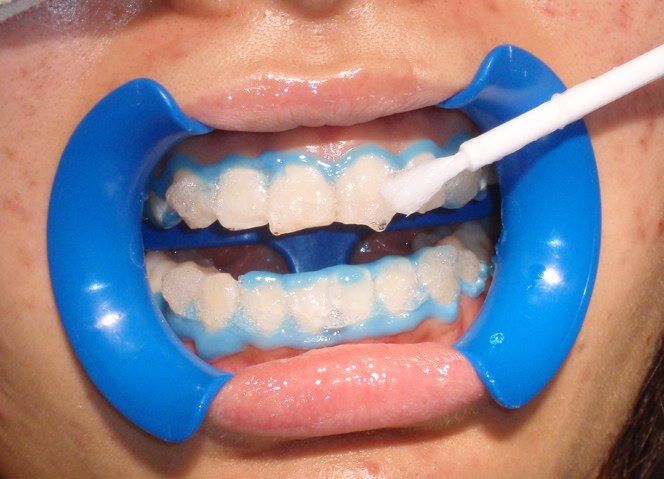 quy trình tẩy trắng răng