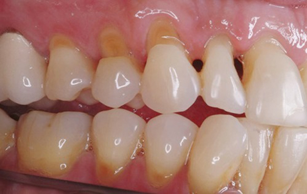 tẩy trắng răng có hại không