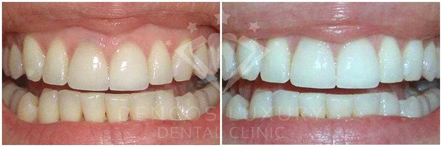 cách giữ răng trắng 7