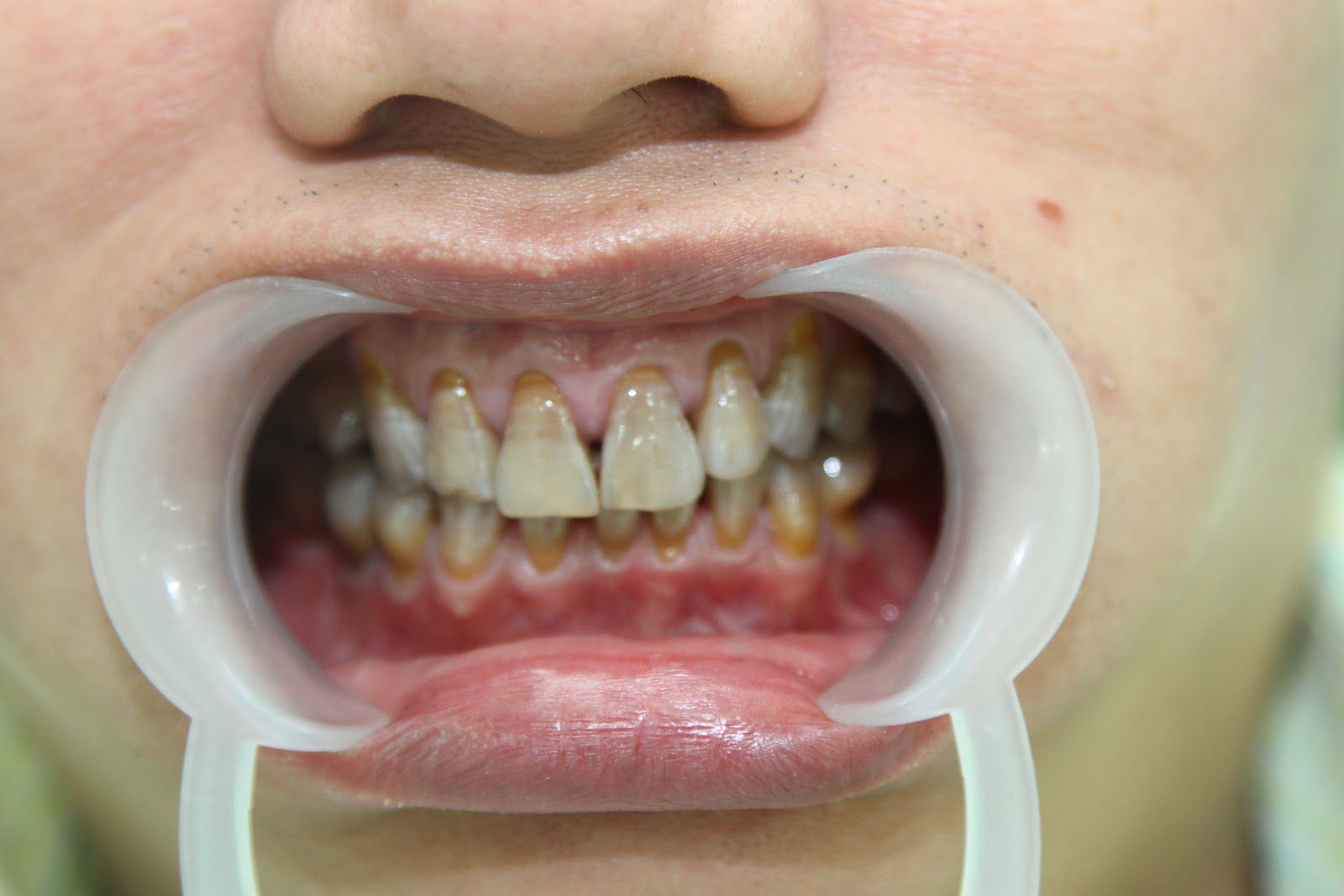 Răng nhiễm kháng sinh có tẩy trắng được không