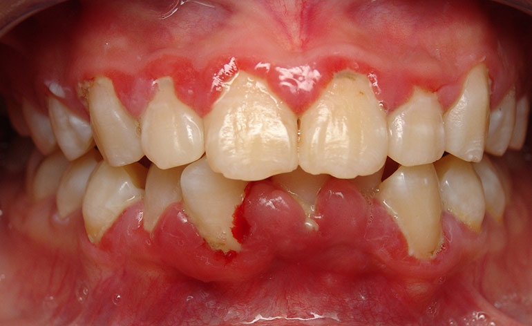 Bệnh nướu răng