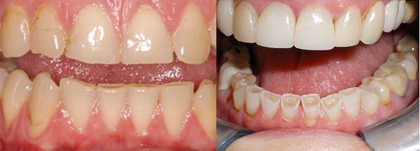 bệnh nghiến răng 4