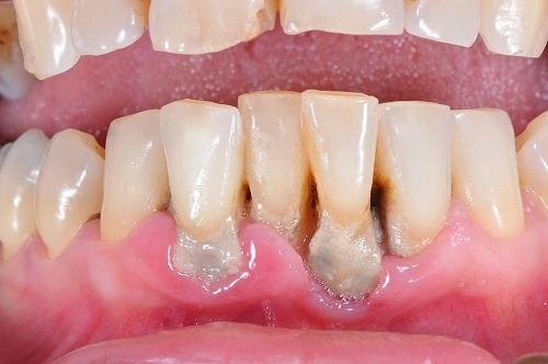 tiêu xương răng là gì