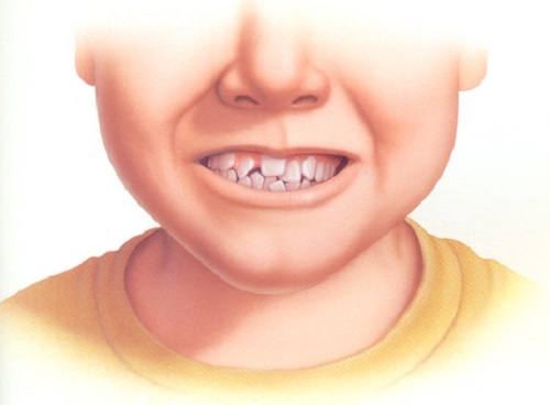 bệnh nghiến răng 2