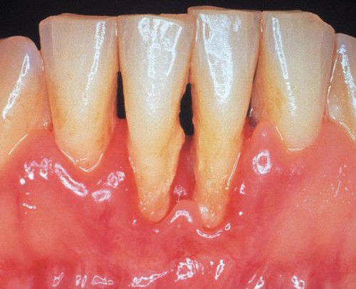 cách chữa bệnh viêm nướu răng 2