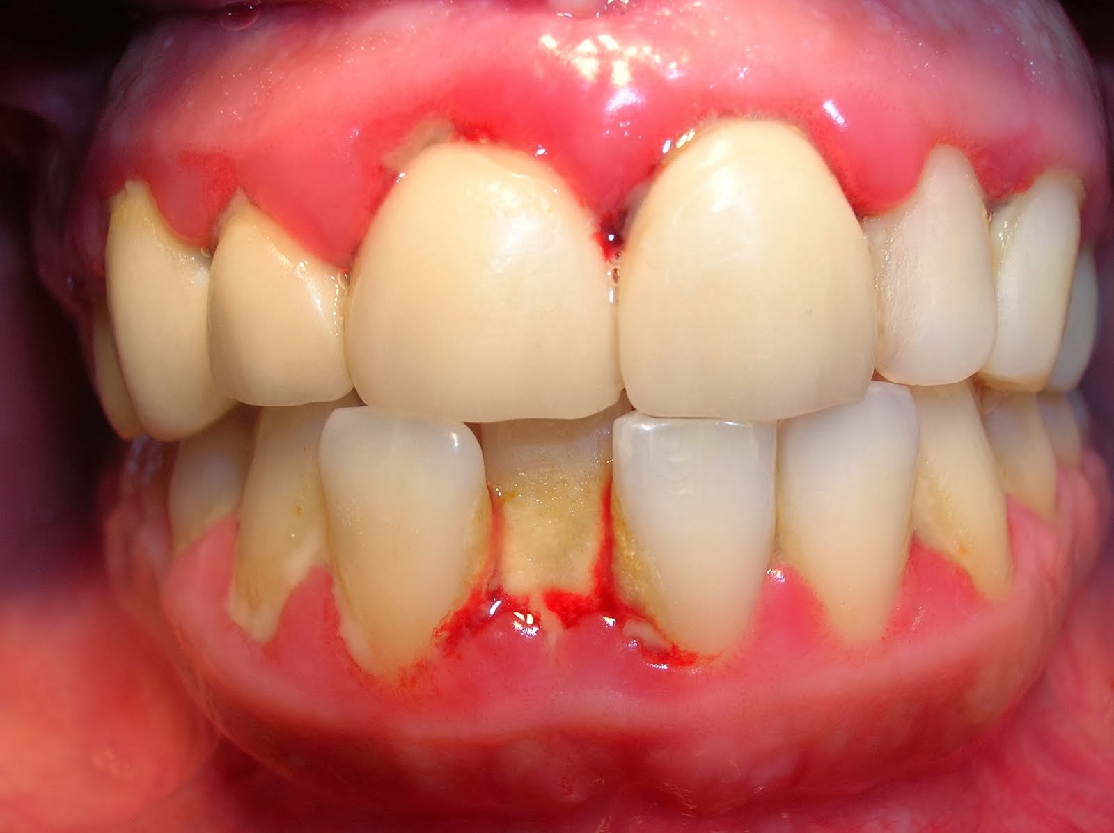 cách chữa bệnh viêm nướu răng 
