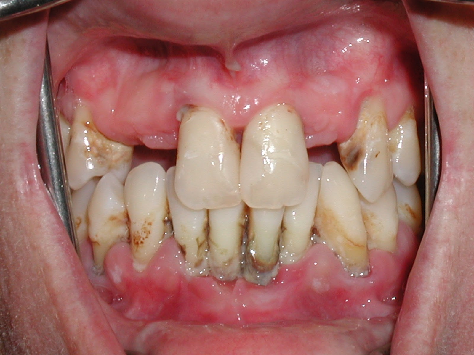 răng nhạy cảm là gì