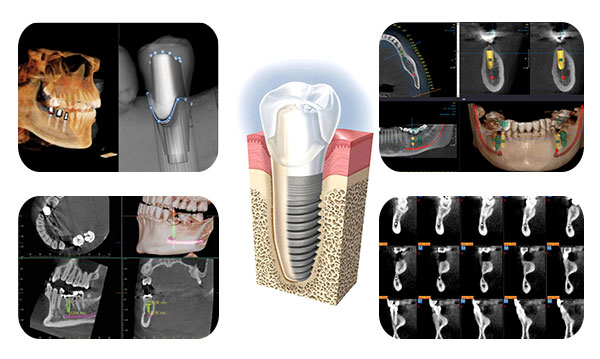 Trồng răng Implant khi mất răng hàm