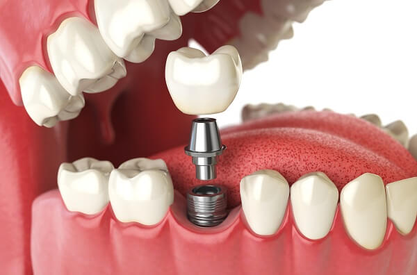 Trồng răng Implant khi mất răng hàm